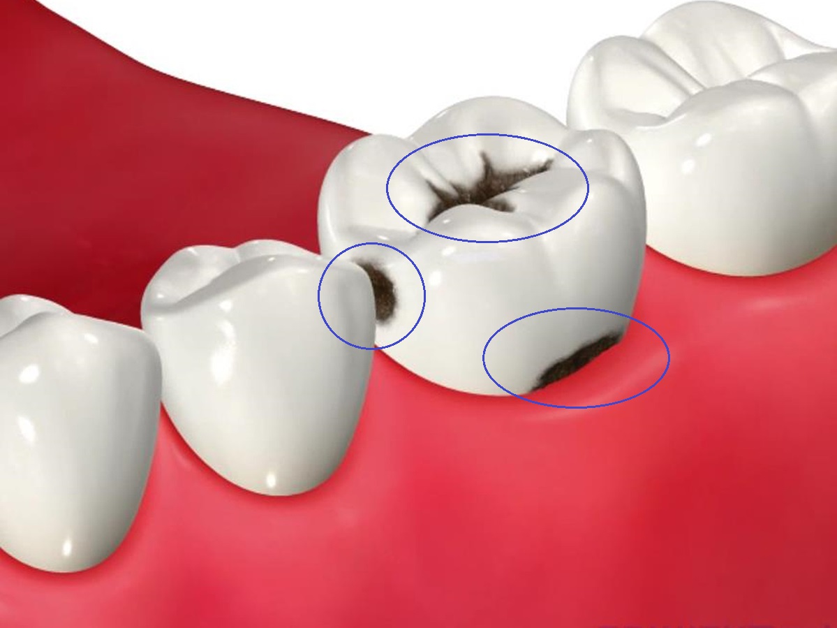 Caries prevention