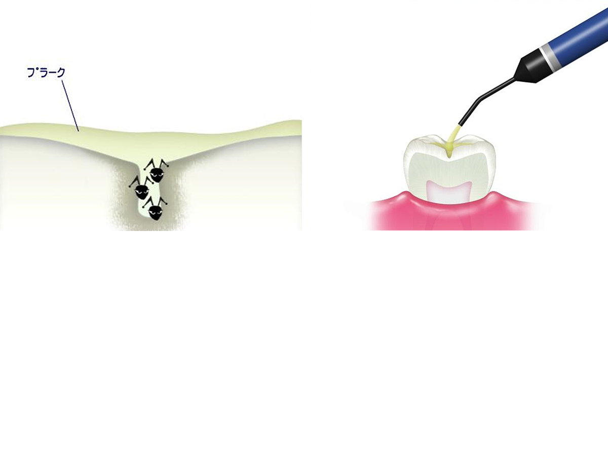 Caries prevention