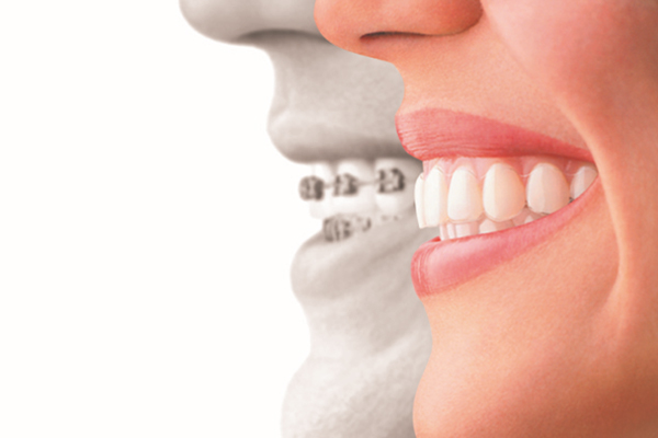 mousepiece orthodontics