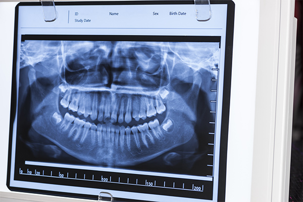 mousepiece orthodontics