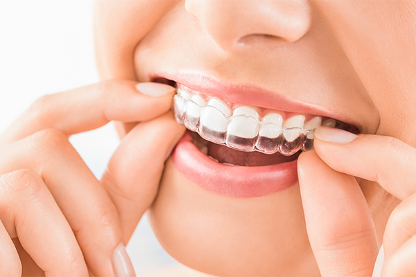 mousepiece orthodontics