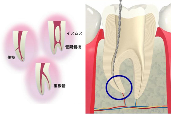 根の治療