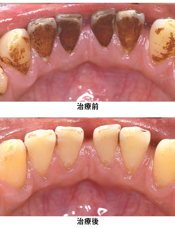 プロフェッショナルケア症例