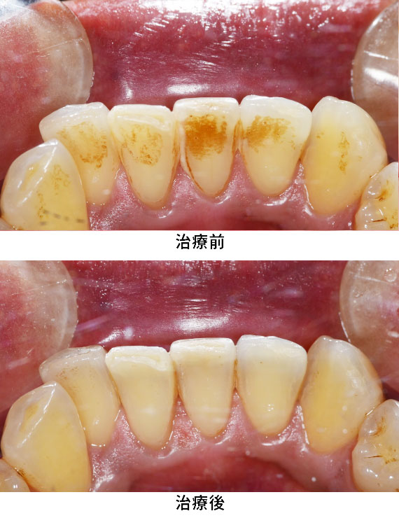 プロフェッショナルケア症例