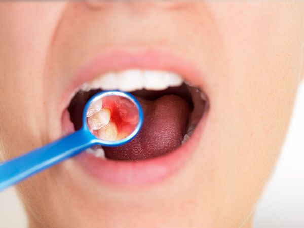 Caries prevention