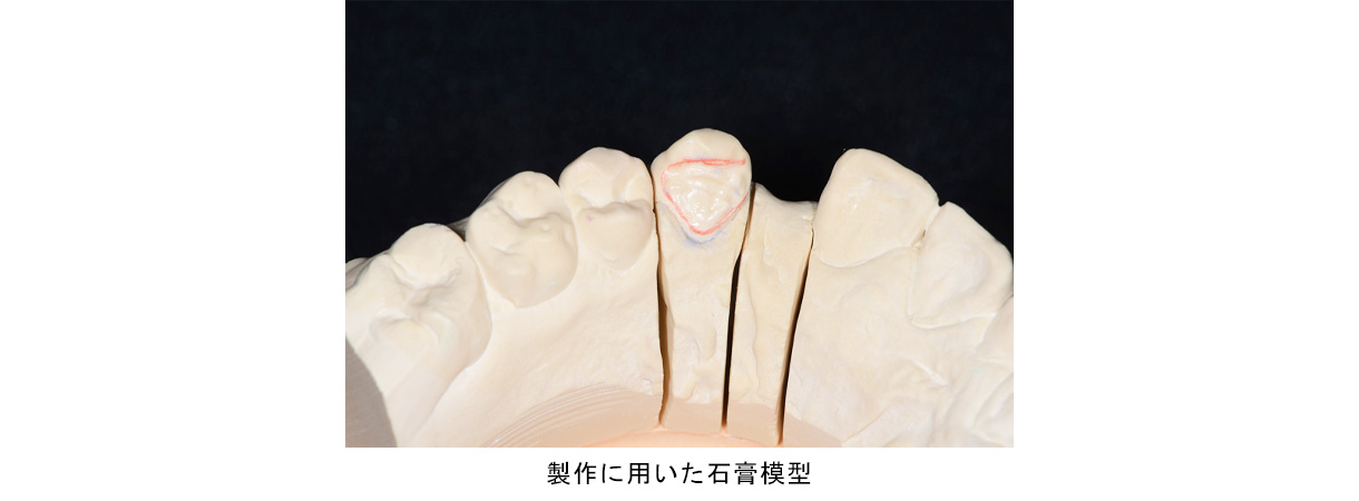 接着ブリッジ