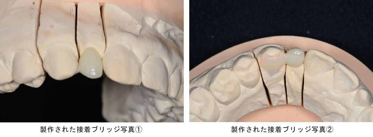 接着ブリッジ