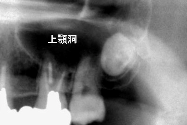 親知らず「抜ける」根拠について