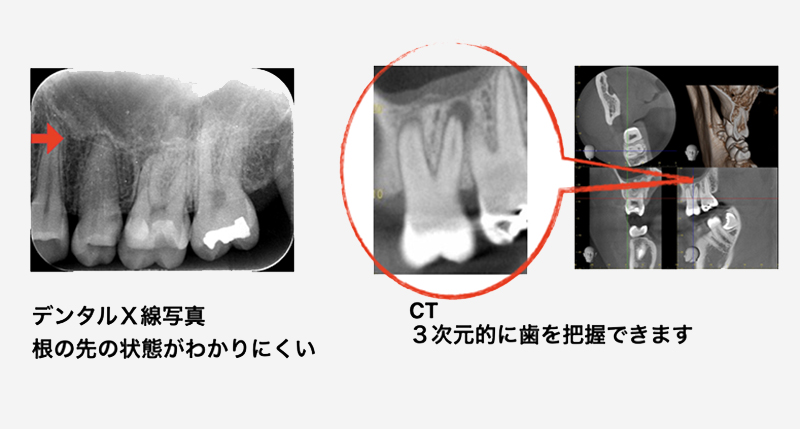 根管治療について