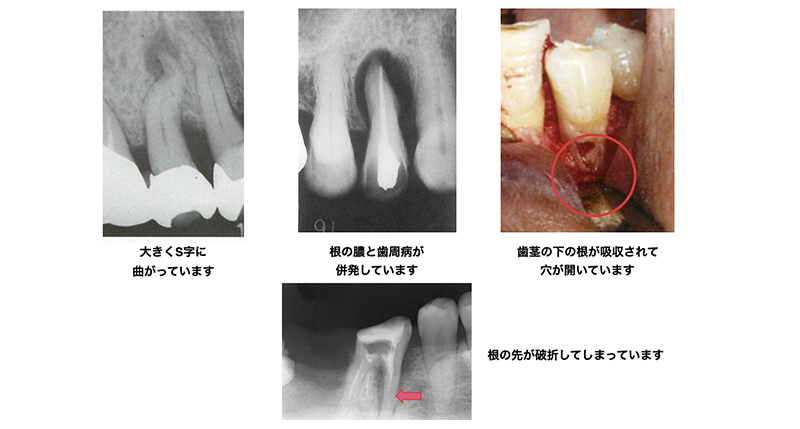 根管治療について