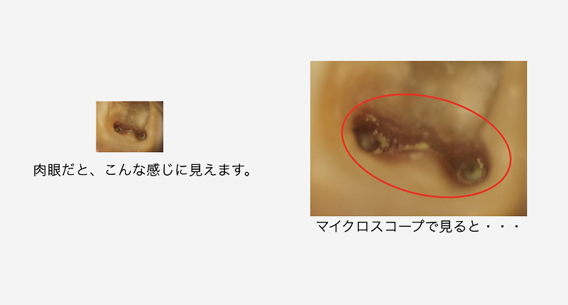 根管治療について