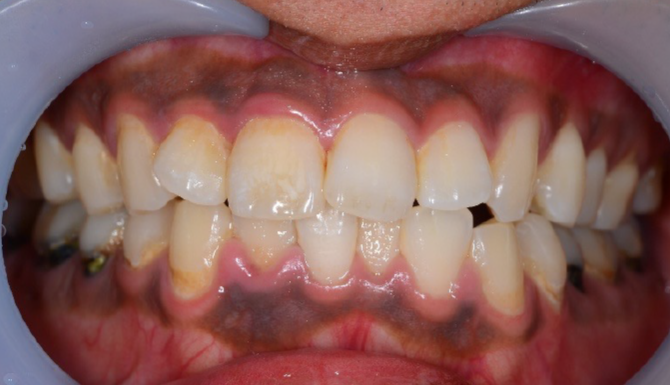 Before
