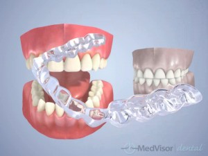 Bruxism treatment