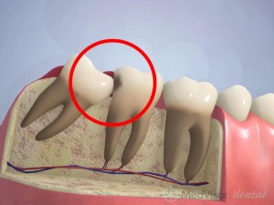 Wisdom teeth risk