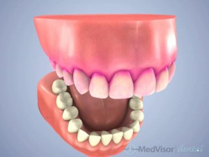 carious plaque control