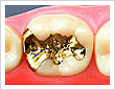 ceramic gold inlay2