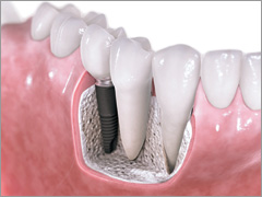 implant fee