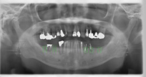 implant inspection
