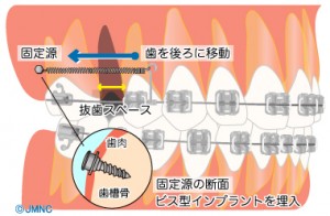 implant orthodontics