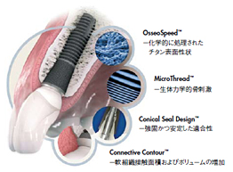 implant structure