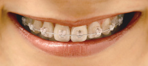 orthodontics fee
