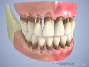 perio symptom