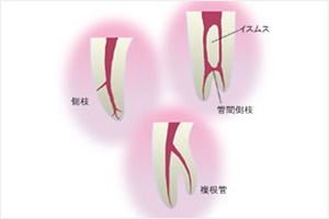 根の治療