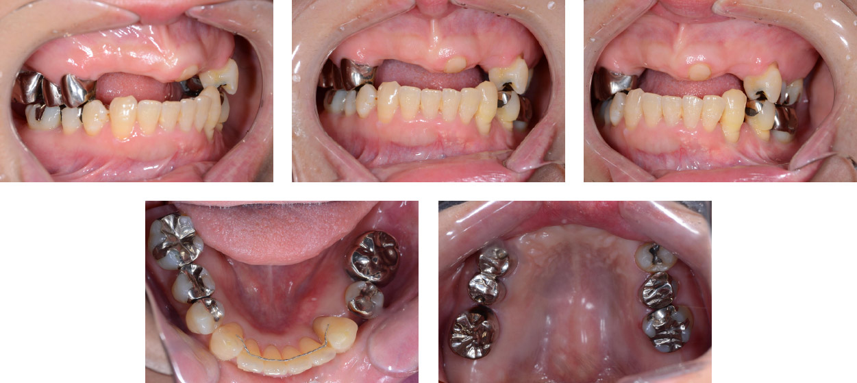 CASE06 自家歯牙移植を用いて臼歯部咬合支持を回復させた症例 | 秋津 