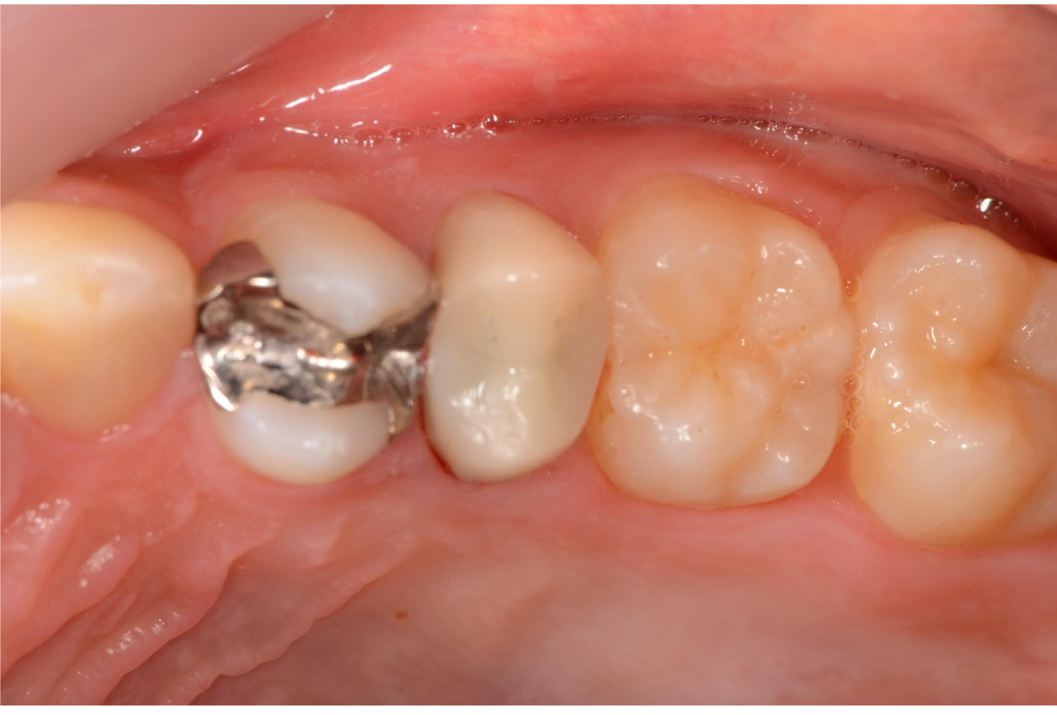 CASE05 根未完成歯の自家歯牙移植を行った症例 | 秋津歯科・矯正歯科｜秋津の歯医者