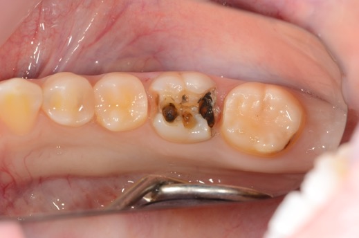 銀歯とセラミックの違い | 秋津歯科・矯正歯科｜秋津の歯医者