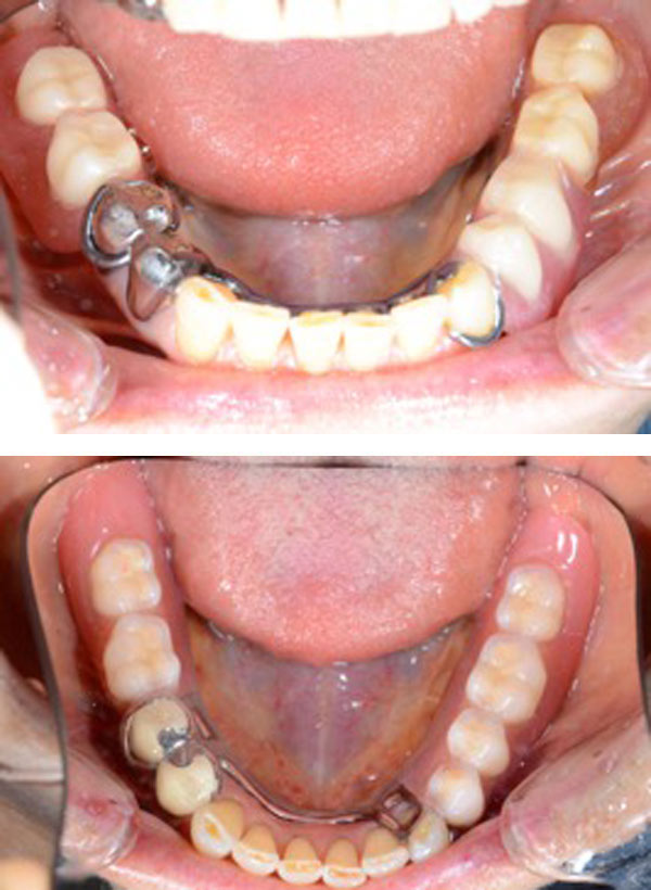 入れ歯 部分 部分入れ歯と総入れ歯で悩んでいます。どちらにしたらいいでしょうか？