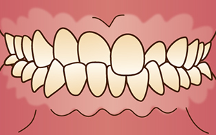 歯並びの悩み