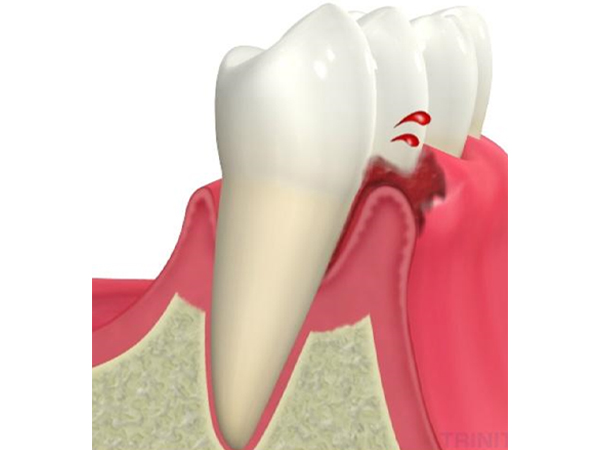 歯周病の因子