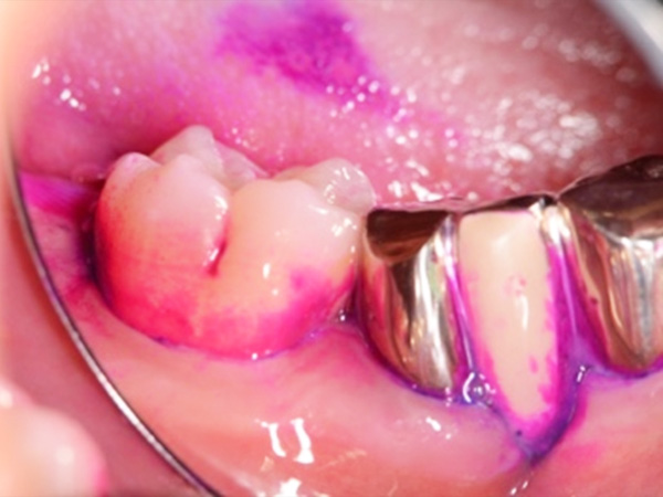 歯周病の因子