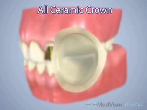 all ceramic crown