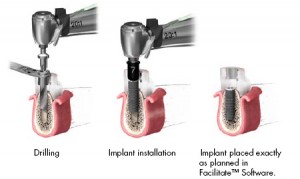 implant method